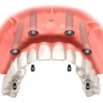 implant diş 3 boyutlu tasarım