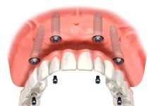 implant diş 3 boyutlu tasarım
