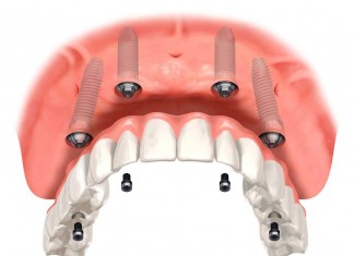 implant diş 3 boyutlu tasarım