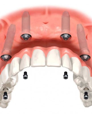 implant diş 3 boyutlu tasarım