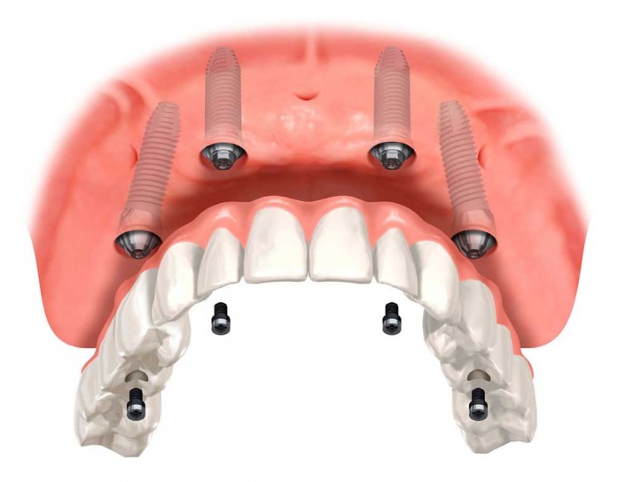 implant diş 3 boyutlu tasarım