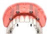 implant diş 3 boyutlu tasarım