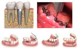 implant diş 3 boyutlu tasarım
